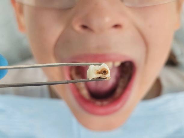 Best Emergency Tooth Extraction  in Hwatha, IA